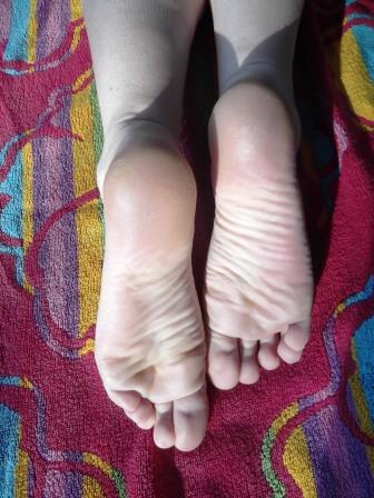 Treating Dry and Cracked Feet - The Links Site